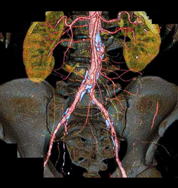Синдром Лериша: 3D-реконструкция КТ-ангиографии брюшной аорты и  подвздошных артерий