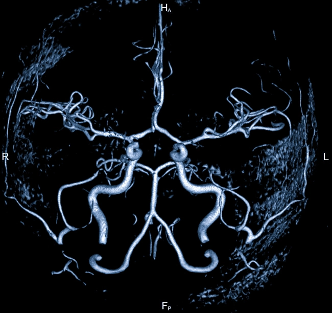 кт артерий головного мозга