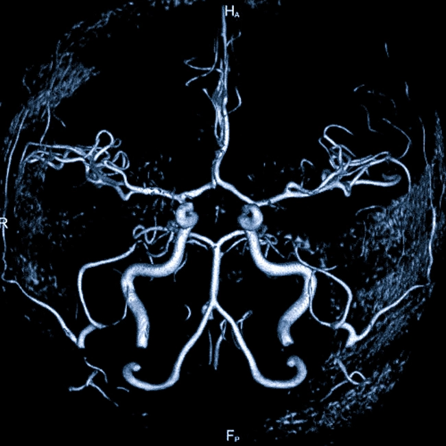КТ артерий головного мозга