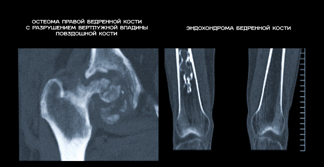 Остеома правой бедренной кости