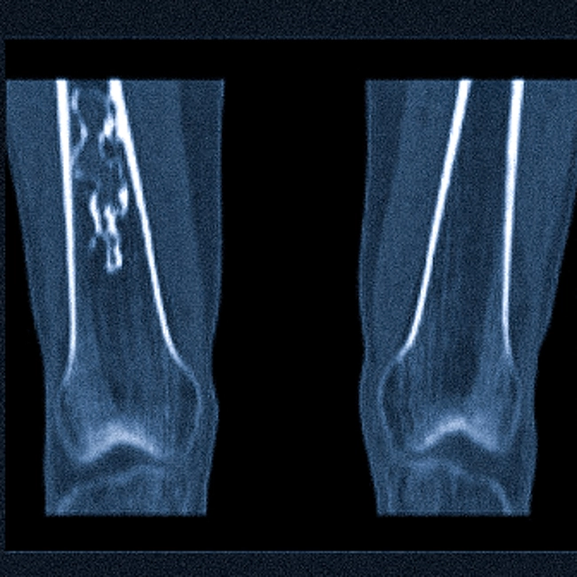 Что показывает КТ бедренной кости, подготовка, показания и противопоказания
