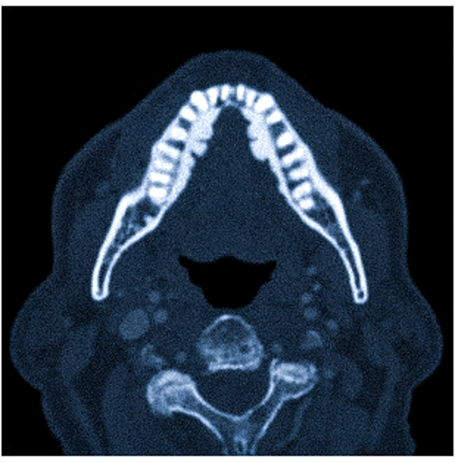 Вариант нормы на КТ челюсти