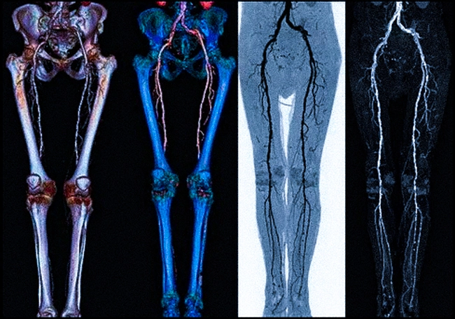 Ангиография нижних конечностей