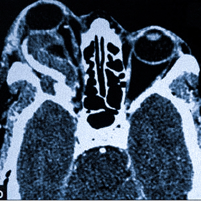 Что показывает КТ глазных орбит, как проходит, подготовка и показания