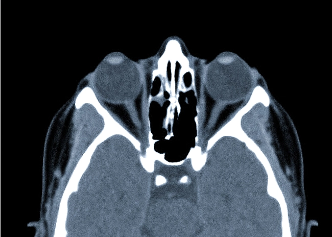 КТ глазных орбит