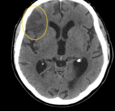 Очаг ишемического инсульта на КТ головного мозга