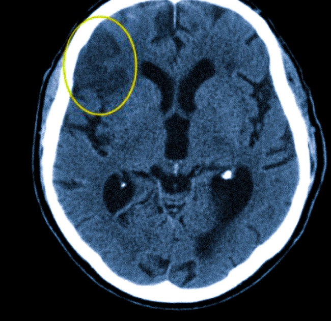 Очаг ишемического инсульта на КТ головного мозга