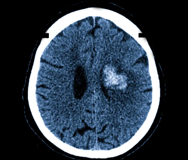 Очаг геморрагического инсульта на снимке КТ