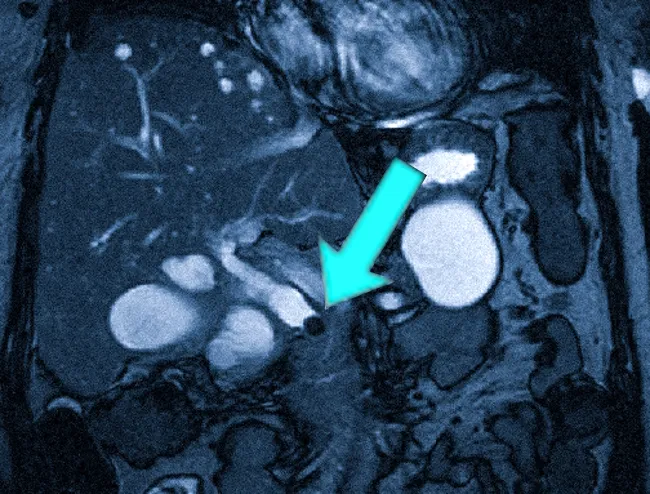 Магнитно-резонансная томограмма: камень в желчном пузыре - холедохолитиаз
