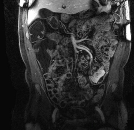 МР-энтерография: лейомиосаркома тонкой кишки