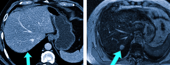 Метастатическое поражение печени на изображениях КТ и МРТ
