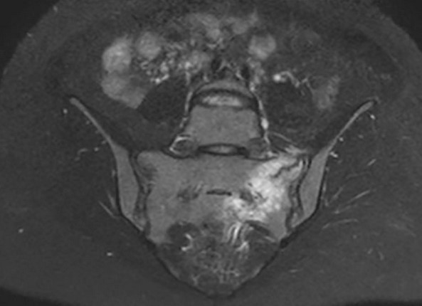 МР-сканирование крестцового отдела позвоночника