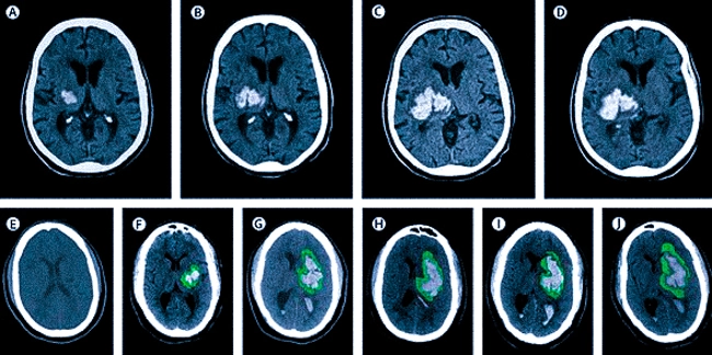 КТ головного мозга: внутричерепное кровоизлияние