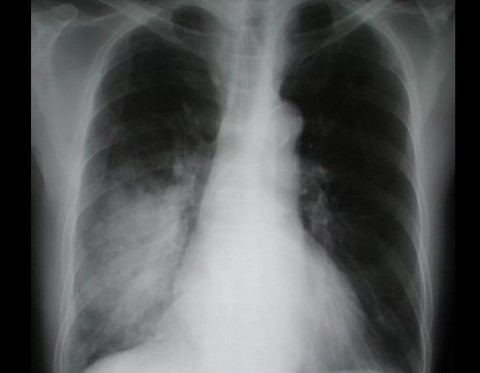 Рентгенография легких при пневмонии