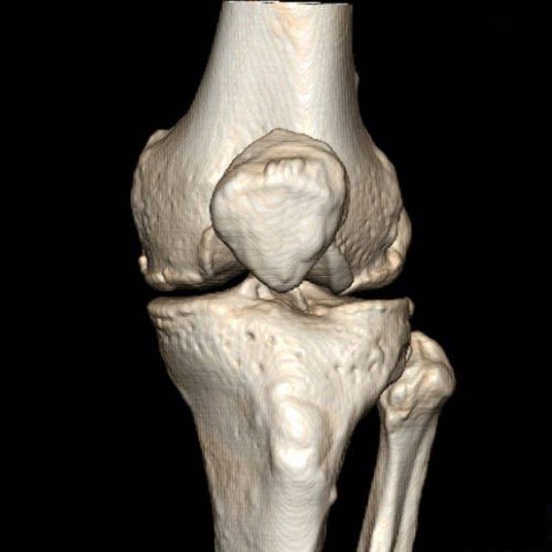 Что показывает КТ коленного сустава, КТ или МРТ, как делают томографию