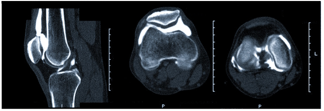 КТ-снимки коленного сустава в норме