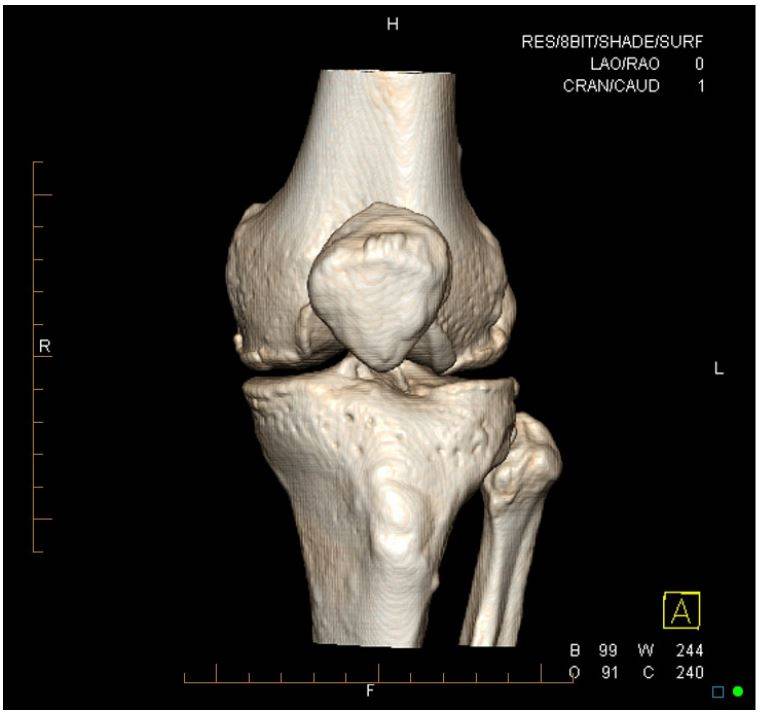 3D-реконструкция, созданная на основе снимков коленного сустава, помогает в разработке схемы оперативного лечения