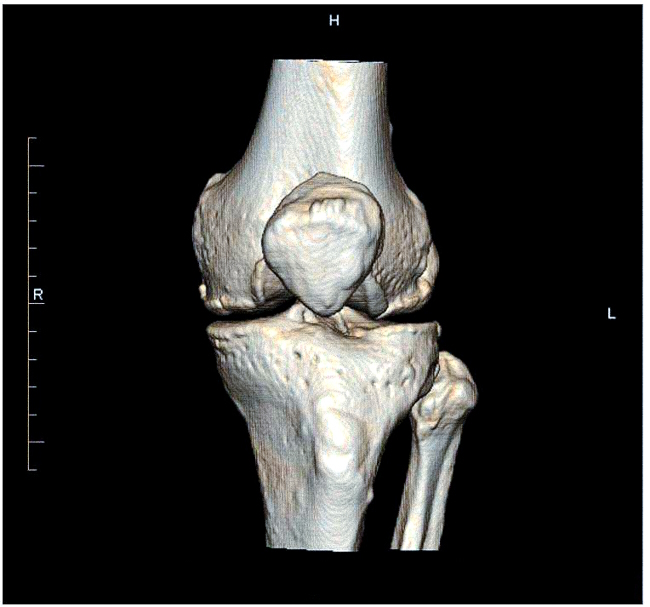 3D-реконструкция, созданная на основе снимков коленного сустава, помогает в разработке схемы оперативного лечения