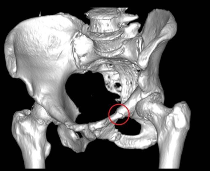 КТ 3D-реконструкция - перелом левой лонной кости в стадии сращения