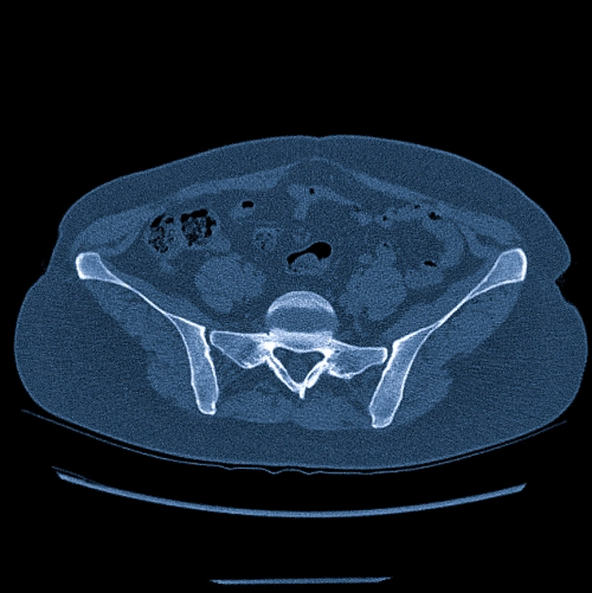 Что показывает КТ костей таза, подготовка, противопоказания