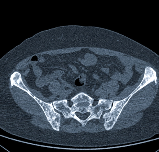 КТ костей таза в аксиальной проекции