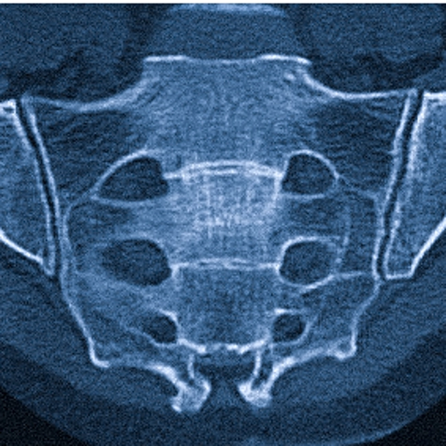 КТ крестцово-подвздошного сочленения
