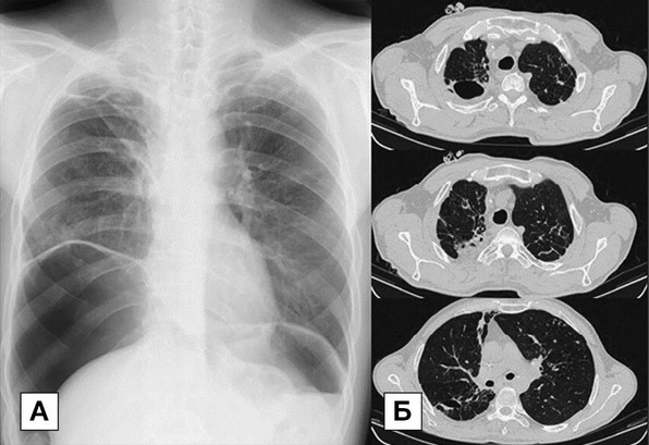 Разница между рентгенографией (А) и компьютерной томографией (Б) грудной клетки