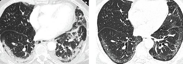 Компьютерная томография легких при коронавирусе: затенения по типу “матового стекла”