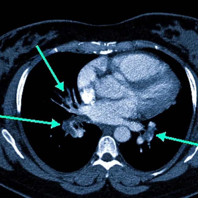 КТ легких при ТЭЛА