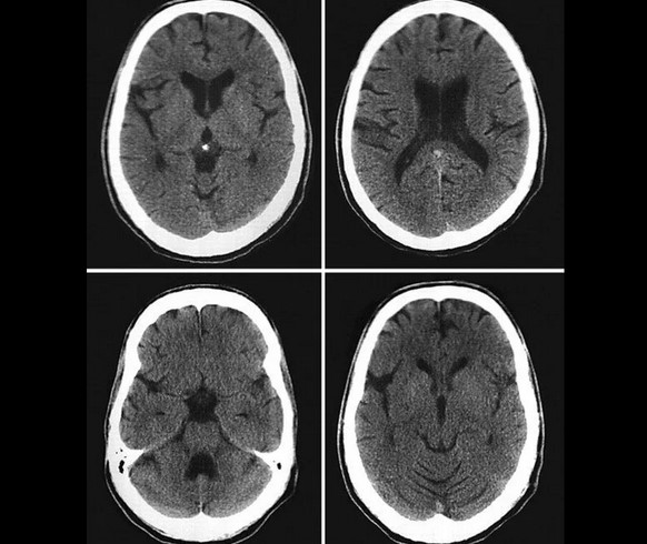 Сканирование головного мозга