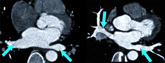 Изображение левого предсердия и легочных вен (обозначены стрелками) на снимках КТ