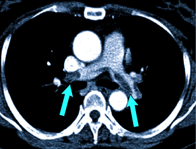 КТ-ангиография легких. Стрелками отмечены легочные артерии на уровне впадения в левое предсердие
