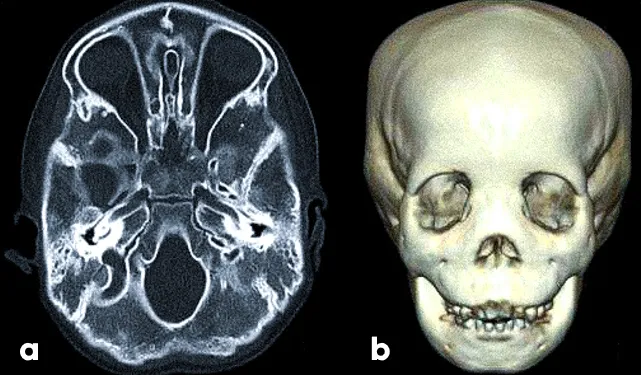 КТ лицевого черепа ребенку