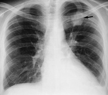 Рентгенография легких: единичная тень в верхней доле слева