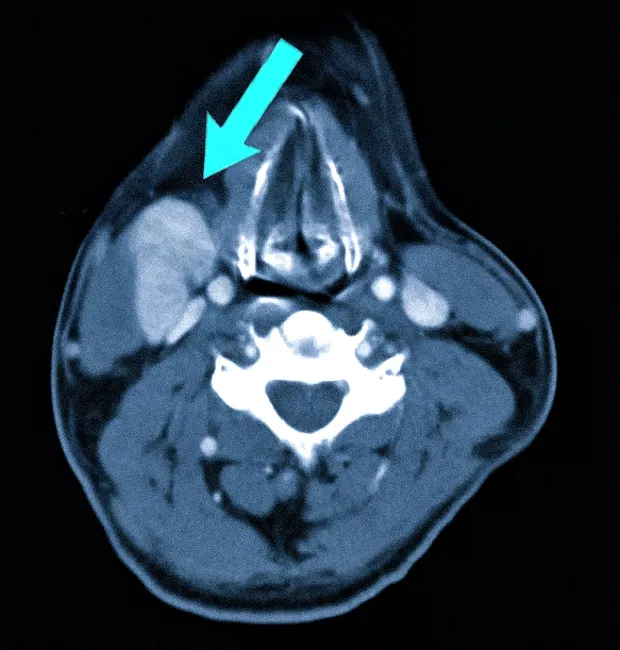 Лимфаденопатия на КТ: стрелка указывает на увеличенный узел
