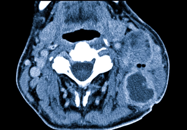 Объемное образование в области шеи слева