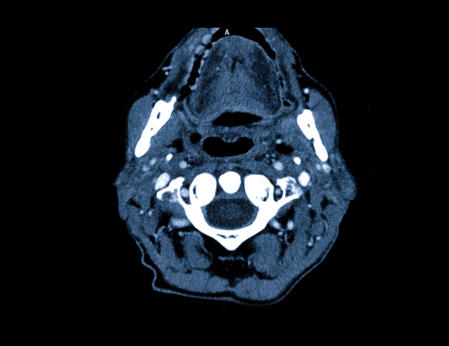 Лимфома шеи на КТ
