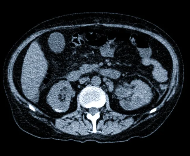 Снимок КТ почек