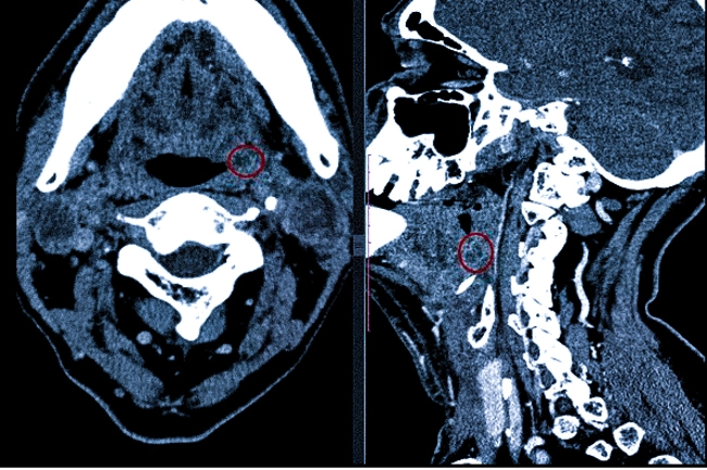 Новообразование в области горла (выделено красным) на снимках КТ