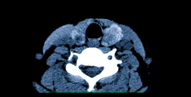 Щитовидная железа на томограмме