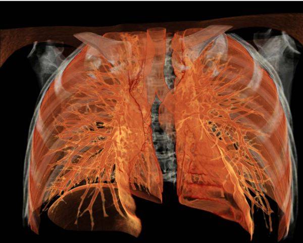 Компьютерная томограмма органов грудной клетки при 3D-реконструкции
