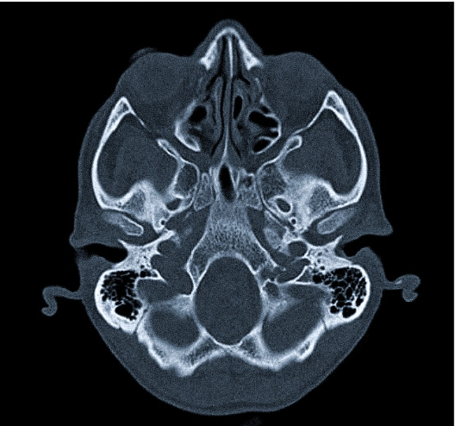 КТ основания черепа фото