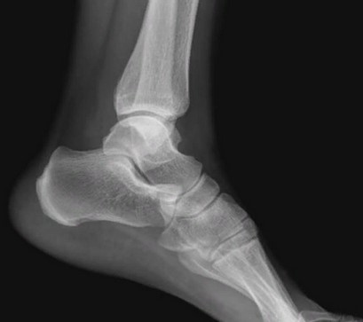 Рентгеновский снимок голеностопного сустава