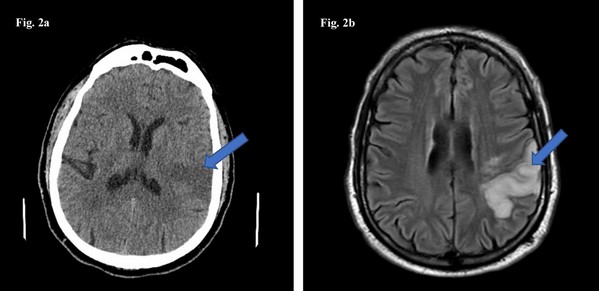 КТ (слева) и МРТ (справа) головы: ишемический инсульт (указан стрелкой)