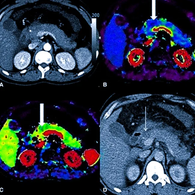 КТ-перфузия поджелудочной железы
