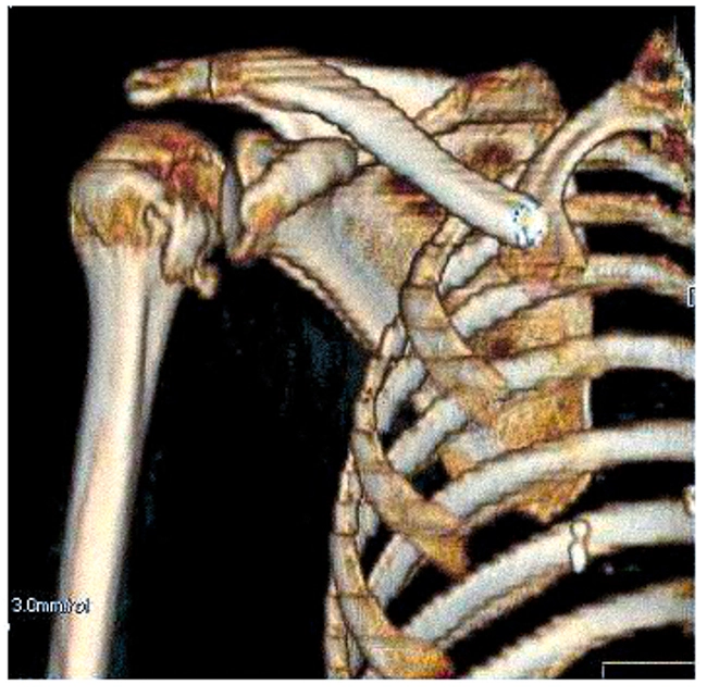 КТ плеча в 3D-реконструкции