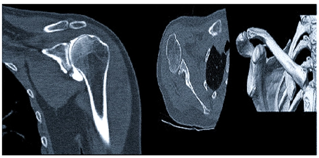 Фото компьютерной томографии плечевого сустава