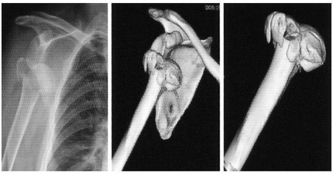 Рентгенограмма и компьютерная томограмма у пациента с тяжелым переломом и вывихом правого плечевого сустава до операции
