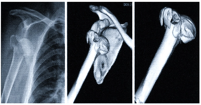 Рентгенограмма и компьютерная томограмма у пациента с тяжелым переломом и вывихом правого плечевого сустава до операции