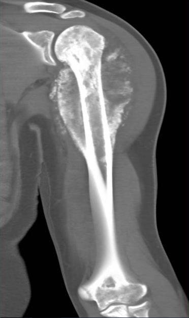 Остеосаркома плечевой кости при компьютерной томографии